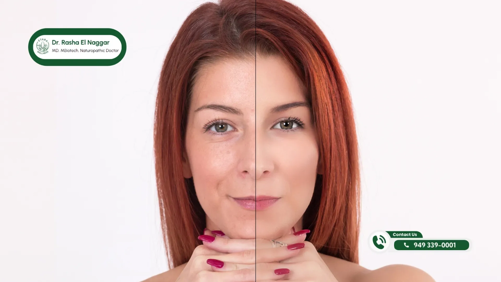 Exosome-therapy-for-skin-rejuvenation-at-Etara-Wellness